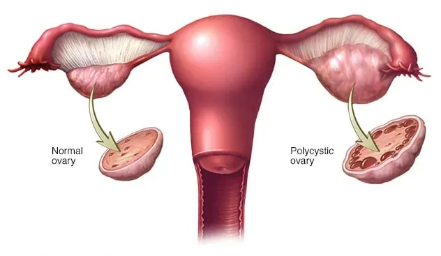 PCOS and Infertility: Understanding the Connection